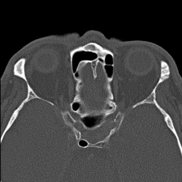 File:Chronic maxillary sinusitis (Radiopaedia 27879-28116 Axial bone window 39).jpg
