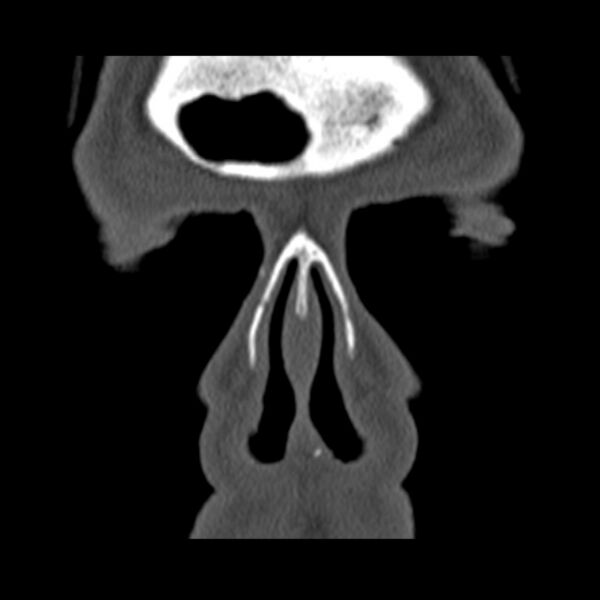 File:Chronic maxillary sinusitis (Radiopaedia 27879-28116 Coronal bone window 5).jpg
