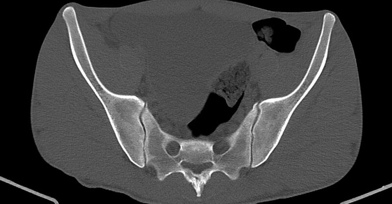 File:Chronic osteomyelitis (with sequestrum) (Radiopaedia 74813-85822 Axial non-contrast 14).jpg