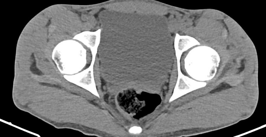 Chronic osteomyelitis (with sequestrum) (Radiopaedia 74813-85822 D 35).jpg