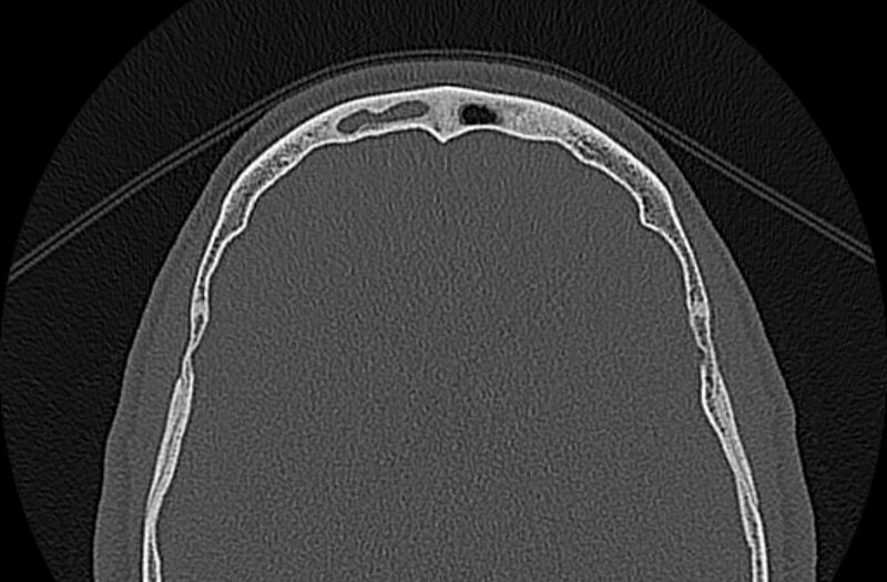 File:Chronic rhinosinusitis (Radiopaedia 65079-74075 Axial bone window 83).jpg