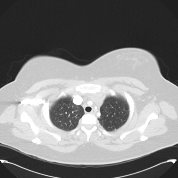 File:Chronic thromboembolic pulmonary hypertension (CTEPH) (Radiopaedia 74597-85531 Axial lung window 11).jpg