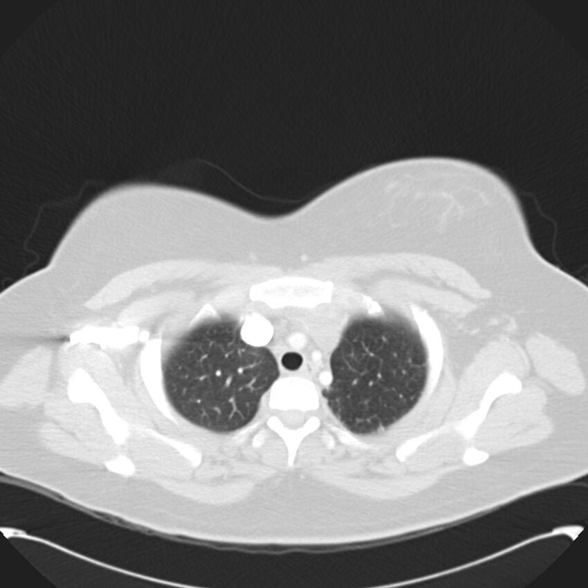Chronic thromboembolic pulmonary hypertension (CTEPH) (Radiopaedia 74597-85531 Axial lung window 11).jpg
