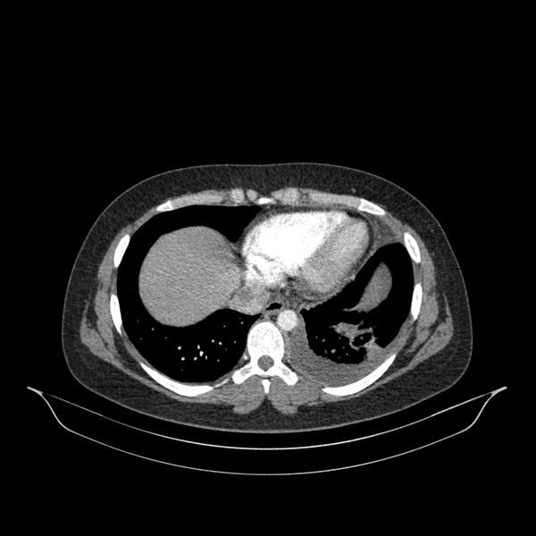 File:Chronic thromboembolic pulmonary hypertension (CTEPH) (Radiopaedia 74597-85532 Axial C+ CTPA 46).jpg