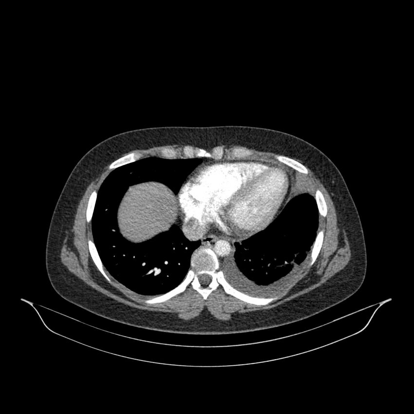 Chronic thromboembolic pulmonary hypertension (CTEPH) (Radiopaedia 74597-85532 Axial C+ CTPA 51).jpg