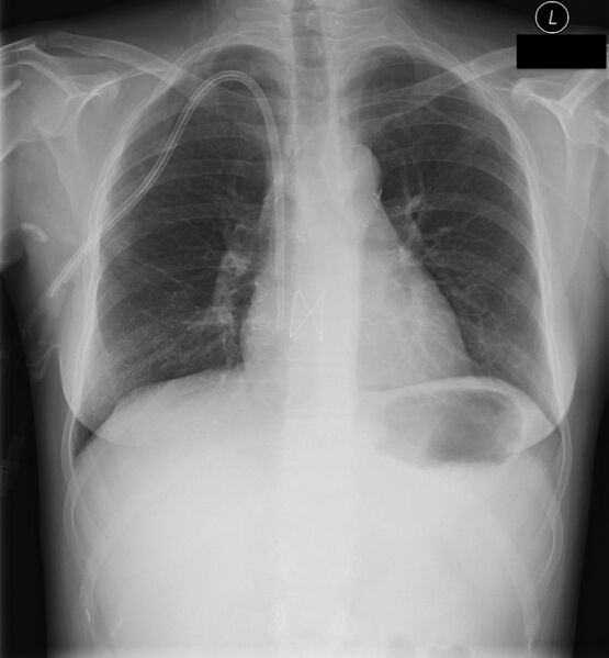 File:Clamshell sternotomy in lung transplantation (Radiopaedia 37324).jpg