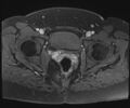 Class II Mullerian duct anomaly- unicornuate uterus with rudimentary horn and non-communicating cavity (Radiopaedia 39441-41755 Axial T1 fat sat 102).jpg