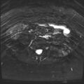 Class II Mullerian duct anomaly- unicornuate uterus with rudimentary horn and non-communicating cavity (Radiopaedia 39441-41755 Axial T2 fat sat 1).jpg
