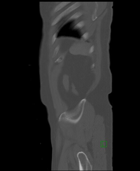 File:Clear cell renal cell carcinoma (Radiopaedia 85006-100539 Sagittal bone window 6).jpg