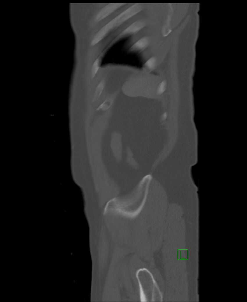 Clear cell renal cell carcinoma (Radiopaedia 85006-100539 Sagittal bone window 6).jpg
