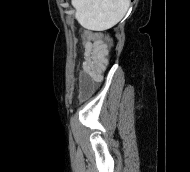 File:Closed loop small bowel obstruction (Radiopaedia 71211-81508 C 151).jpg