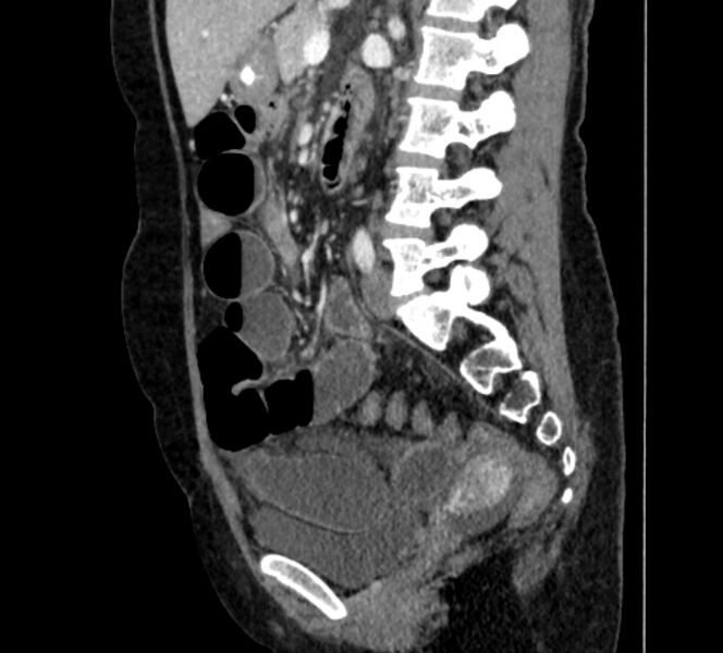 File:Closed loop small bowel obstruction (Radiopaedia 71211-81508 C 86).jpg