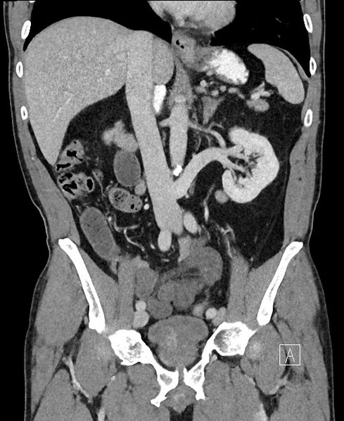 File:Closed loop small bowel obstruction - internal hernia (Radiopaedia 57806-64778 A 57).jpg