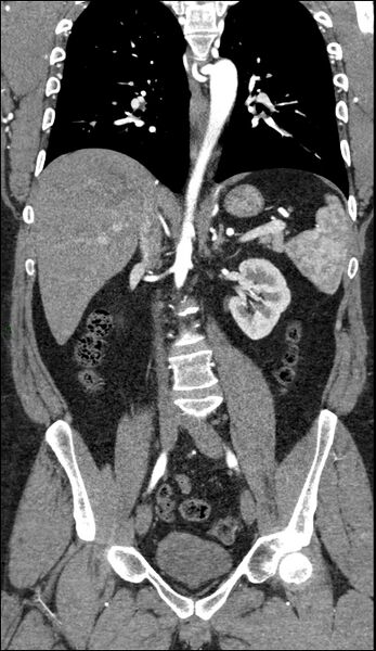 File:Coarctation of the aorta (Radiopaedia 74632-88521 B 137).jpg