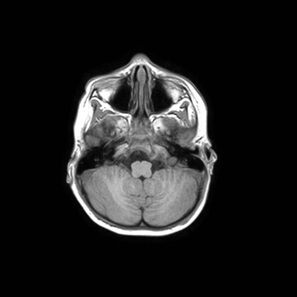 File:Cochlear nerve aplasia - unilateral (Radiopaedia 87910-104413 Axial T1 8).jpg