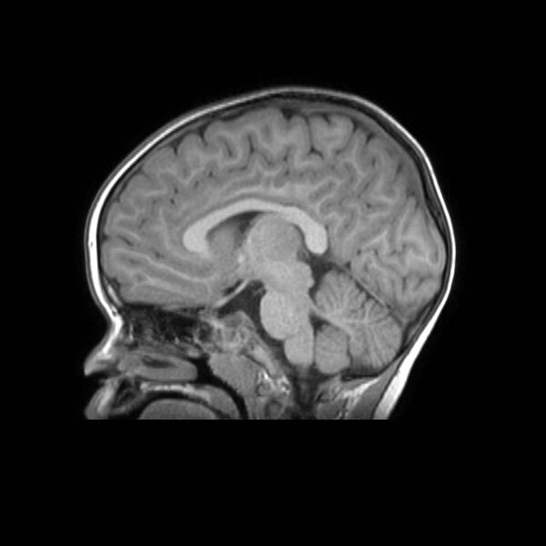 File:Cochlear nerve aplasia - unilateral (Radiopaedia 87910-104413 Sagittal T1 23).jpg