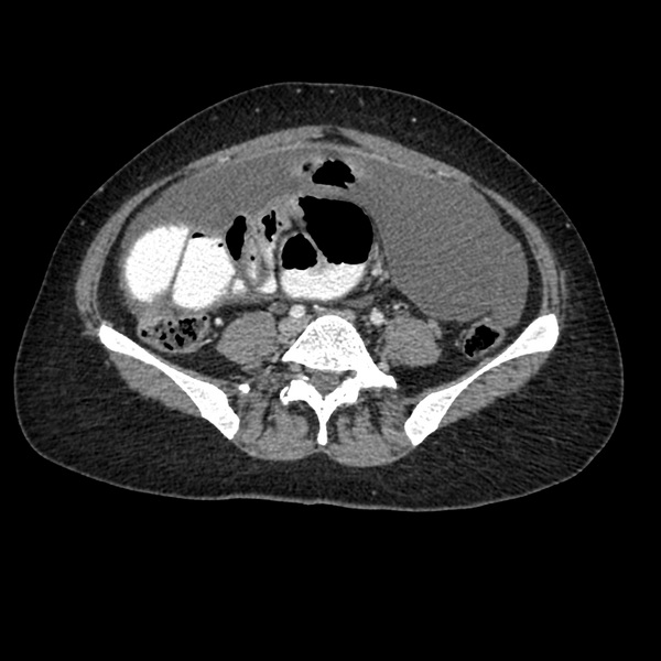 File:Cocoon abdomen with possible tubo-ovarian abscess (Radiopaedia 46235-50636 A 29).png