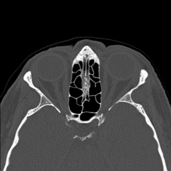 File:Nasal septal perforation (Radiopaedia 25030-25289 Axial bone window 44).jpg