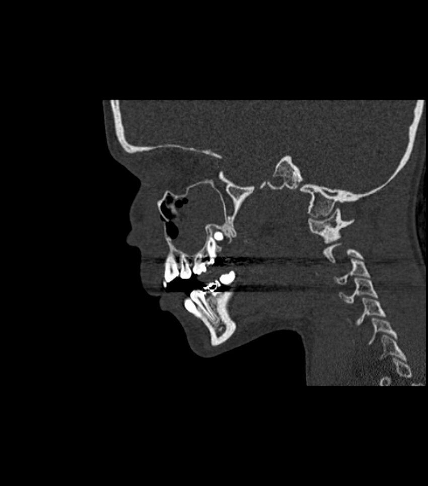 Nasoorbitoethmoid fracture (Radiopaedia 90044-107205 Sagittal bone window 92).jpg