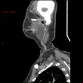 Nasopharyngeal lymphoma (Radiopaedia 54235-60433 B 50).jpg
