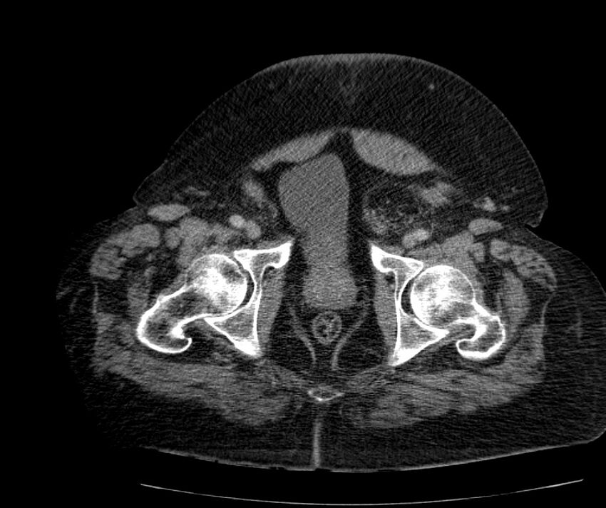 Nephroptosis with inguinal hernia containing perirenal fat (Radiopaedia 56632-63391 C 317).jpg