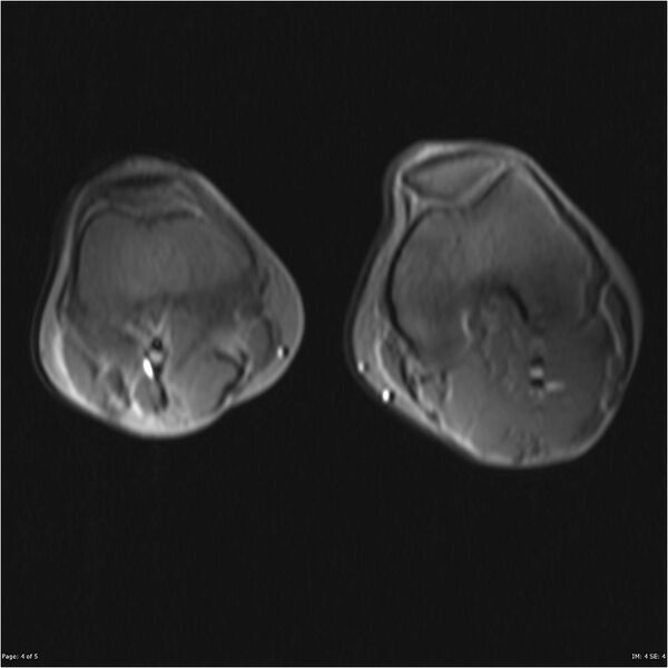 File:Neurofibromatosis type 1 (Radiopaedia 22541-22566 Axial Localiser 2).jpg