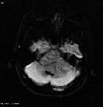 Neurofibromatosis type 2 - cranial and spinal involvement (Radiopaedia 5351-7111 Axial DWI 1).jpg