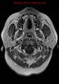 Neuroglial cyst (Radiopaedia 10713-11184 Axial T1 C+ 23).jpg