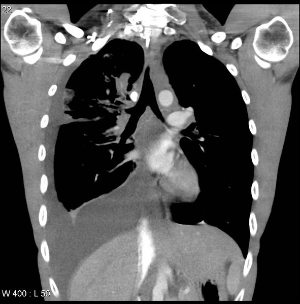 File:Non-Hodgkin lymphoma involving lung (Radiopaedia 29094-29470 C 16).jpg