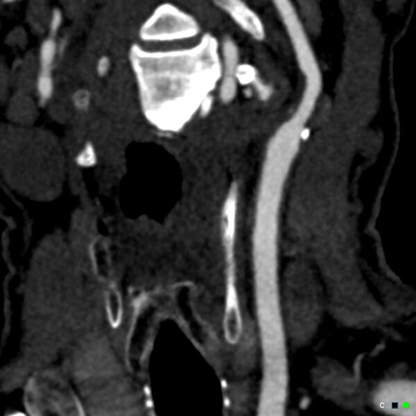 File:Non-occlusive intraluminal internal carotid artery thrombus (Radiopaedia 37751-39658 C 70).jpg