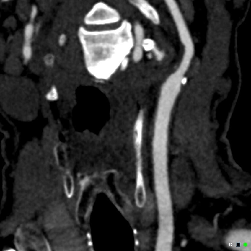 Non-occlusive intraluminal internal carotid artery thrombus (Radiopaedia 37751-39658 C 70).jpg