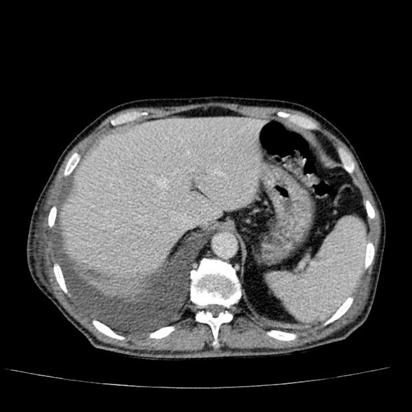 File:Non small-cell lung cancer (Radiopaedia 24467-24769 C+ delayed 56).jpg