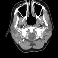 Normal CT of the neck (Radiopaedia 14575-14500 Axial C+ 20).jpg