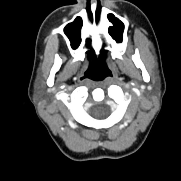 File:Normal CT of the neck (Radiopaedia 14575-14500 Axial C+ 22).jpg