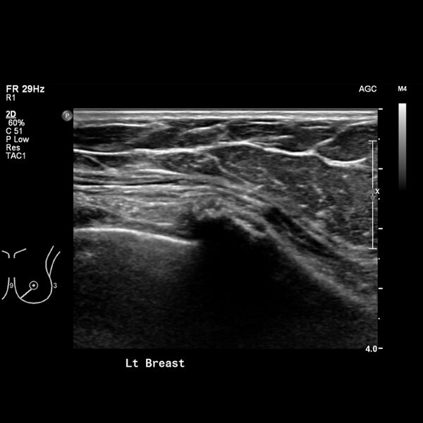 File:Normal breast mammography (tomosynthesis) and ultrasound (Radiopaedia 65325-74354 Left breast 9).jpeg