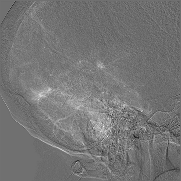File:Normal cerebral angiogram (four vessel DSA) (Radiopaedia 41708-44649 R 17).png