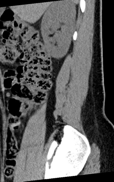 File:Normal lumbar spine CT (Radiopaedia 46533-50986 C 93).png