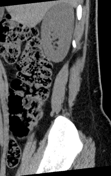 File:Normal lumbar spine CT (Radiopaedia 46533-50986 C 99).png