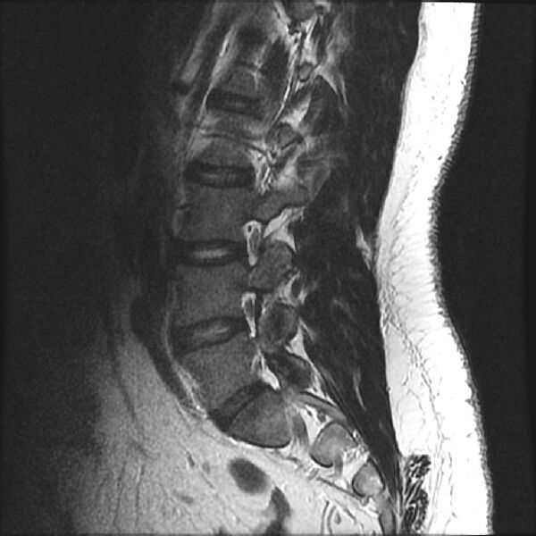 File:Normal lumbar spine MRI (Radiopaedia 43051-46311 Sagittal T2 15).jpg