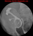 Normal retrograde pyelography of a native and transplant kidney (Radiopaedia 40480-43054 Transplant kidney 15).jpg
