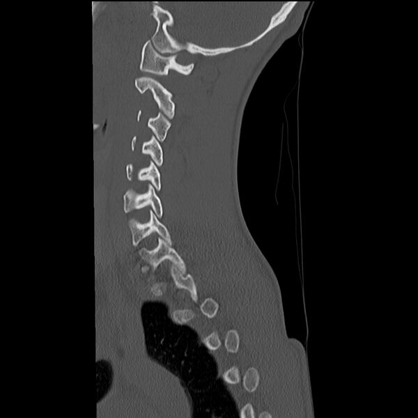 File:Normal trauma spine imaging (age 16) (Radiopaedia 45335-49358 Sagittal bone window 28).jpg