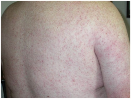 Diffuse maculopapular rash associated with West Nile virus infection.