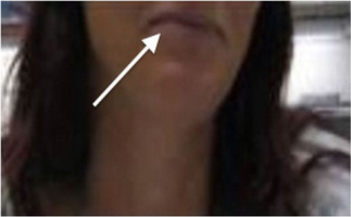 White arrow indicates blue/grey discoloration of lips