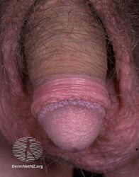 Pearly penile papules