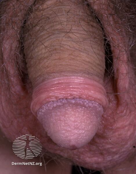 File:Pearly penile papules (DermNet NZ penile-pearly-papules-01).jpg