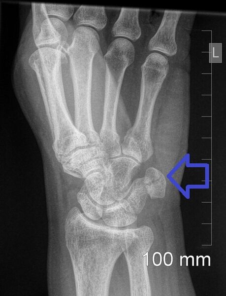 File:Pisiform fracture (Radiopaedia 52465).jpeg