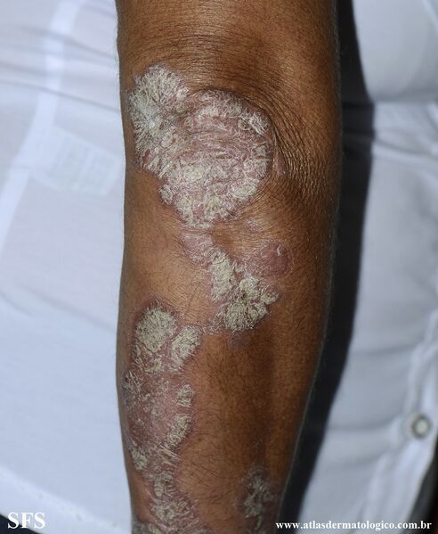 File:Psoriasis (Dermatology Atlas 161).jpg
