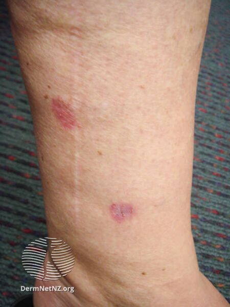 File:Superficial basal cell carcinoma, leg (DermNet NZ sbcc-leg-12-dn).jpg