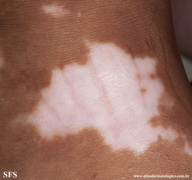 File:Vitiligo (Dermatology Atlas 52).jpg