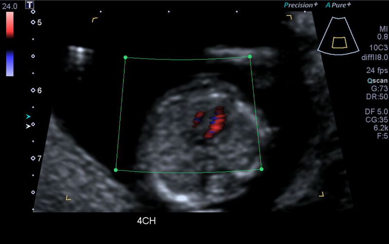 File:1st trimester nuchal-morphology ultrasound (Radiopaedia 44706-48477 Heart views cine with colour 63).jpg